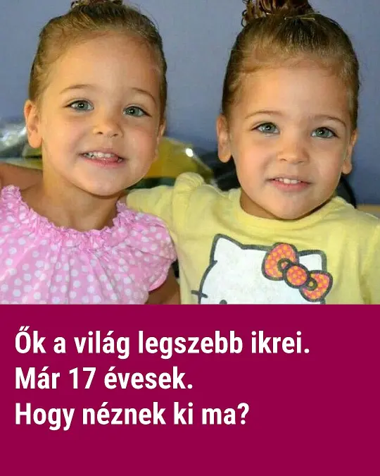 7 eves korukban a vilag legszebb ikreknek tartottak oket es igy neznek ki most10